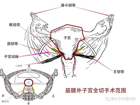 子宫切了可打新冠疫苗吗