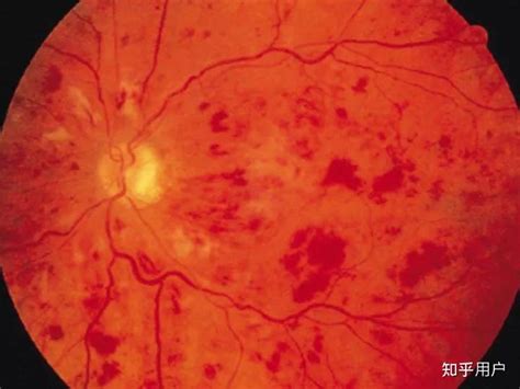 脑部毛细血管出血