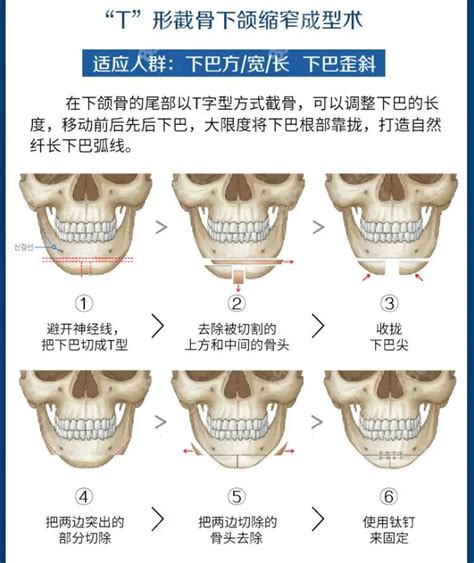 颏成型手术过程
