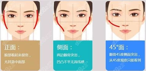 颧弓外扩和颧骨高的区别图片
