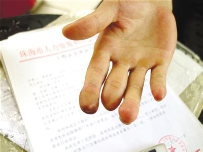 手指缺失伤残鉴定标准